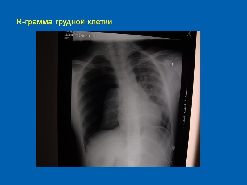 R-грамма грудной клетки